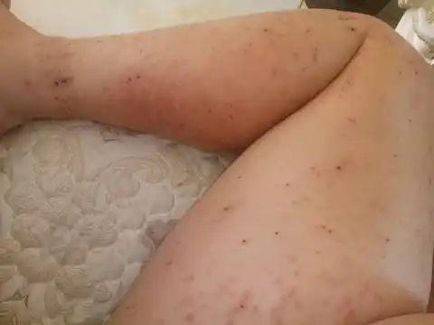 妊娠痒疹 一个月了还不好,每晚都睡不着.有图慎入