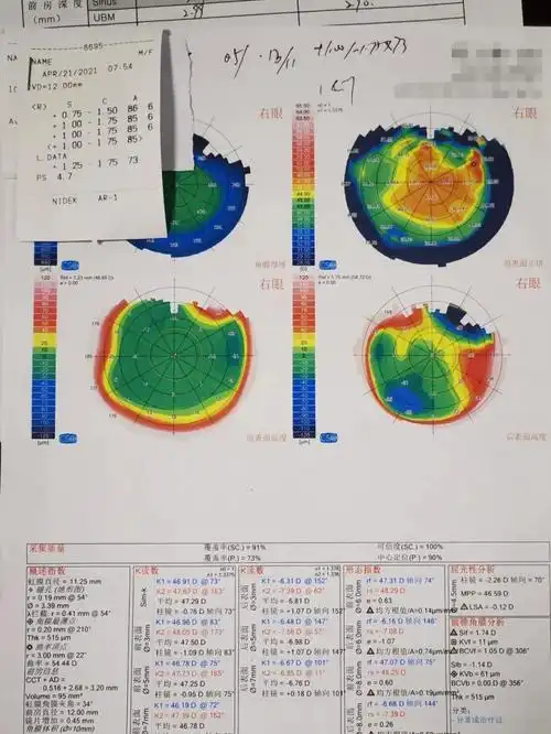 河北2700度超高度近视姐姐摘镜后变化超级大