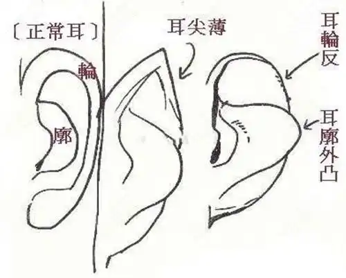 耳廓骨凸出,导致耳朵有反骨而且耳贴脑袋,耳廓不形成