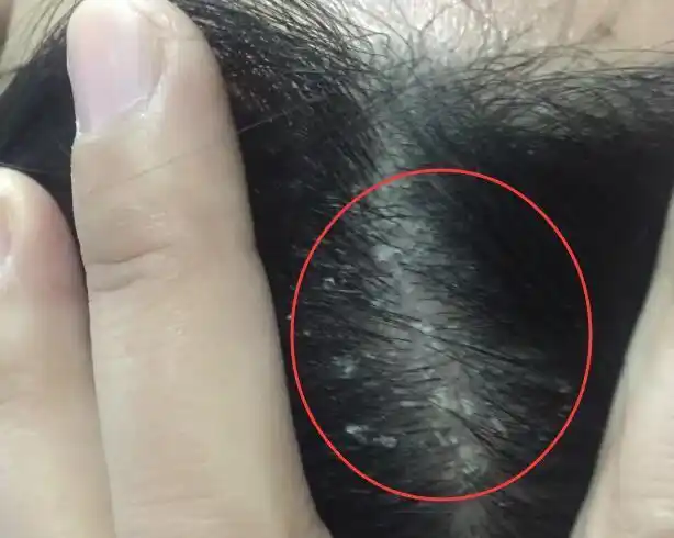 头皮越挠越痒能抠出来像头屑一样的白色东西是怎么回事