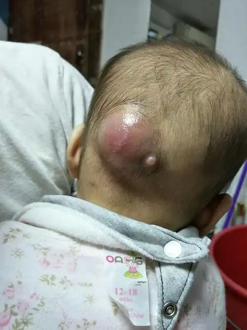 小孩头部长这个东西怎么回事儿