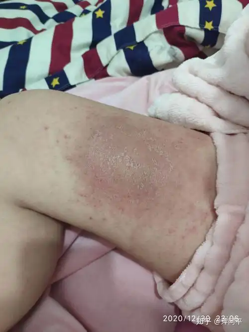 记录20201225湿疹