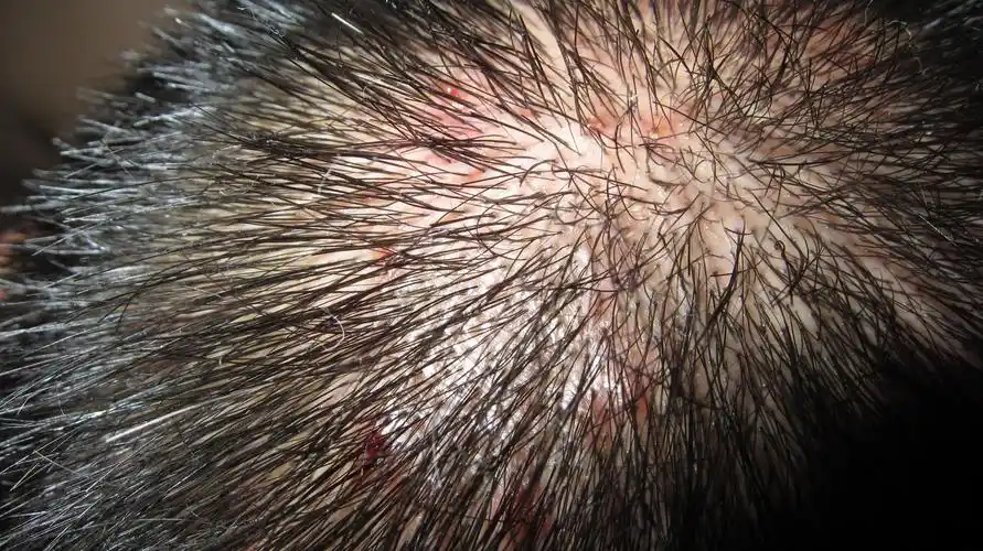 求妙手治疗穿凿性毛囊炎