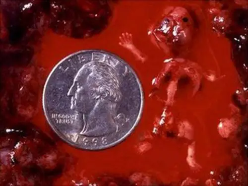 台湾流产专家_台湾治疗流产哪个专家好_台湾治疗流产最好的专家/排行