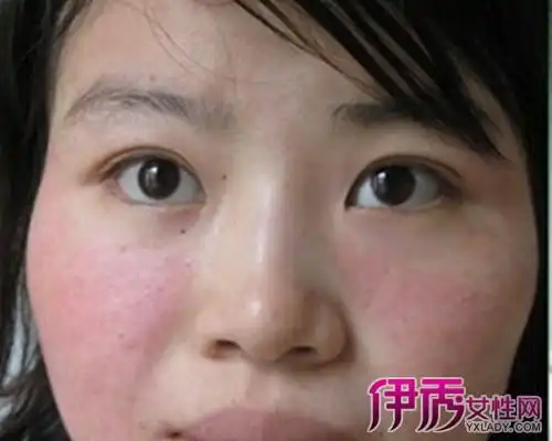 【图】成人面部湿疹图片展现 分析此病的病因及治疗方案