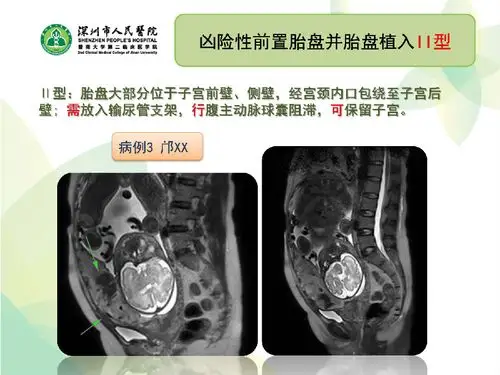 苏放明教授谈:凶险性前置胎盘的诊断分型及分型处理