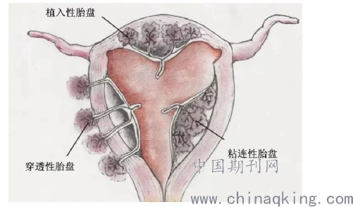 胎盘植入的产前超声诊断你知道吗