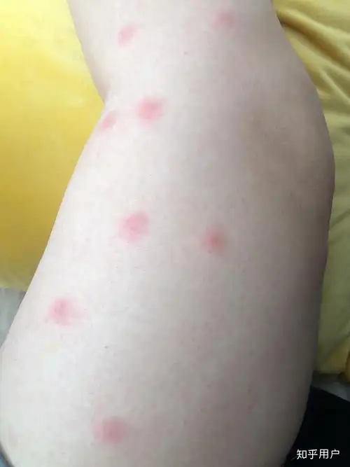 蚊虫叮咬后红包上有小水泡,把小水泡挤破水流出来就不痒了.
