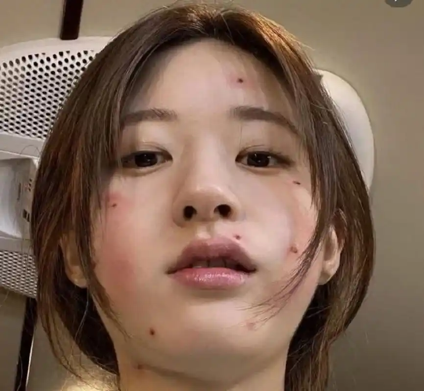 赵露思的脸怎么了,长痘痘了还是点痣?