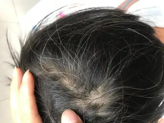 孩子长白头发,不一定是营养不良,也有可能是这些原因导致的