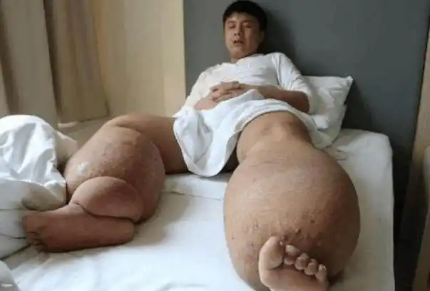 刚出生后不久被蚊虫叮咬了,后来就患上了这种怪病,丝虫病,俗称大象腿.