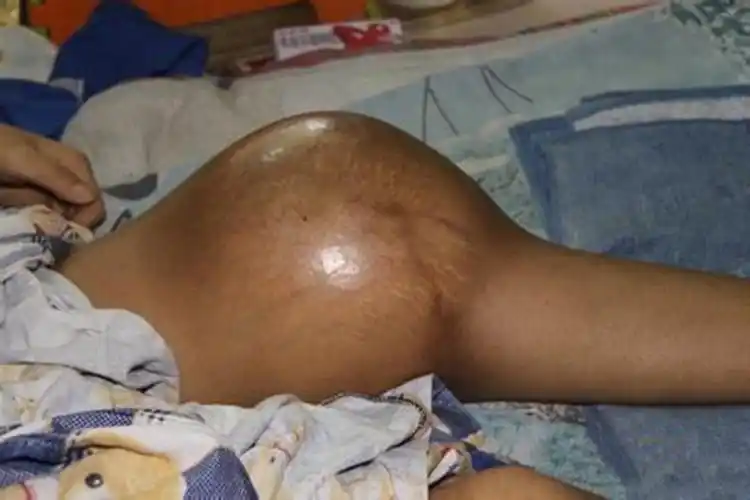 腿部巨大骨肉瘤图片