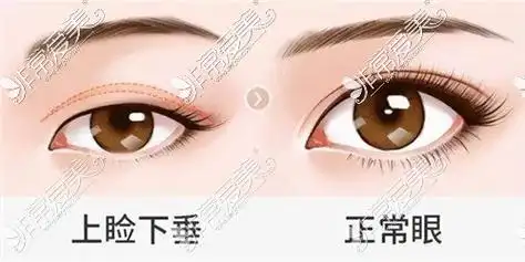 揭秘双眼皮提肌骗局告诉你做完全切双眼皮提肌后感受