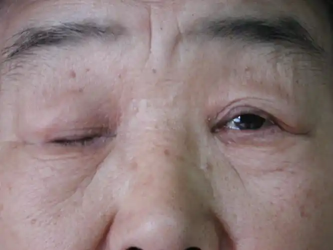 重症肌无力克星—微创胸腺切除 - 好大夫在线