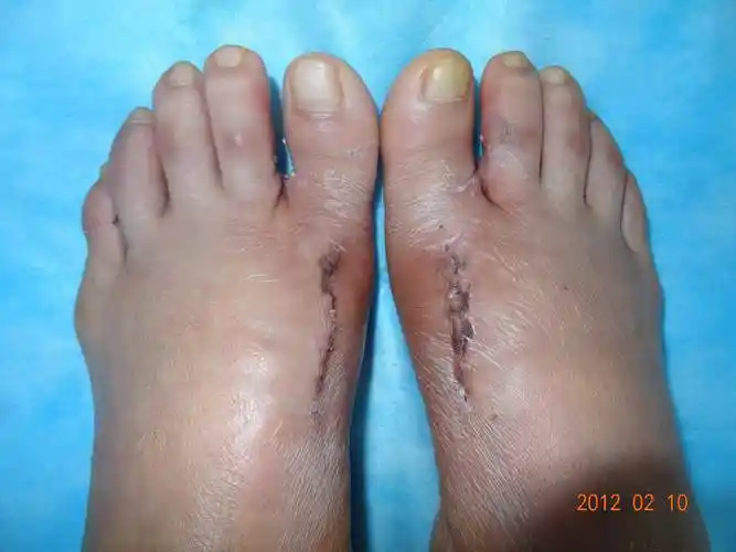 2012年第一例拇外翻(更新图片) - 好大夫在线