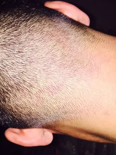 不知道怎么回事头皮忽然发红,不痛不痒的第一天很红第二点轻了一点是