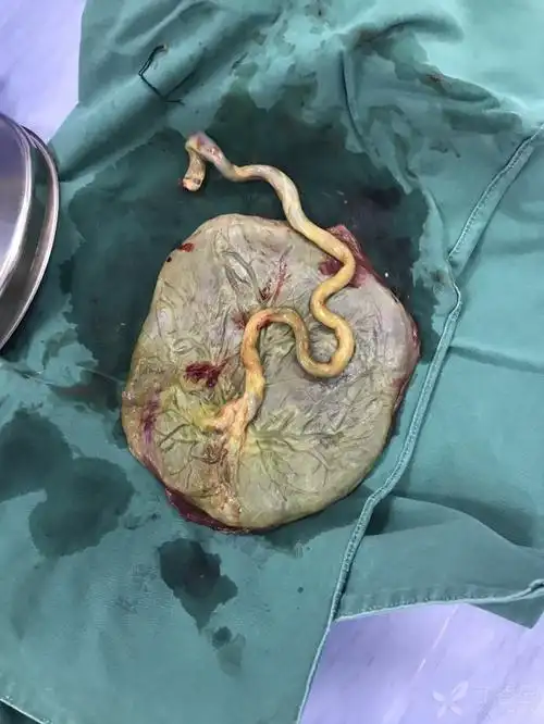 人工破膜未见前羊水,经阴道分娩,新生儿8到10分,羊水3度粪染,胎盘胎儿