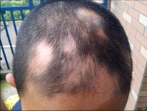 同事家的孩子,13岁的小男孩,2年前就有这种掉头发的现象,后来在老家一
