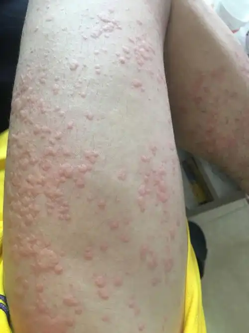 我昨天下午身体突然起一小点红的疙瘩,慢慢的就红成一片昨天打了针