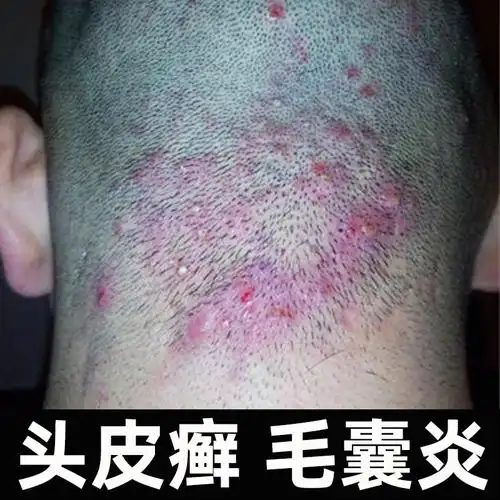 毛囊炎专用药头皮瘙痒止痒抑菌软膏癣药膏正品真菌克星癣洗发水