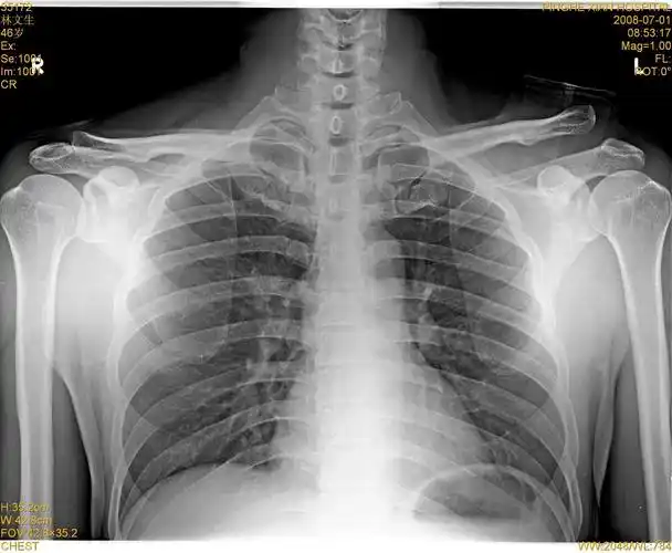 左肩锁关节脱位及复位后