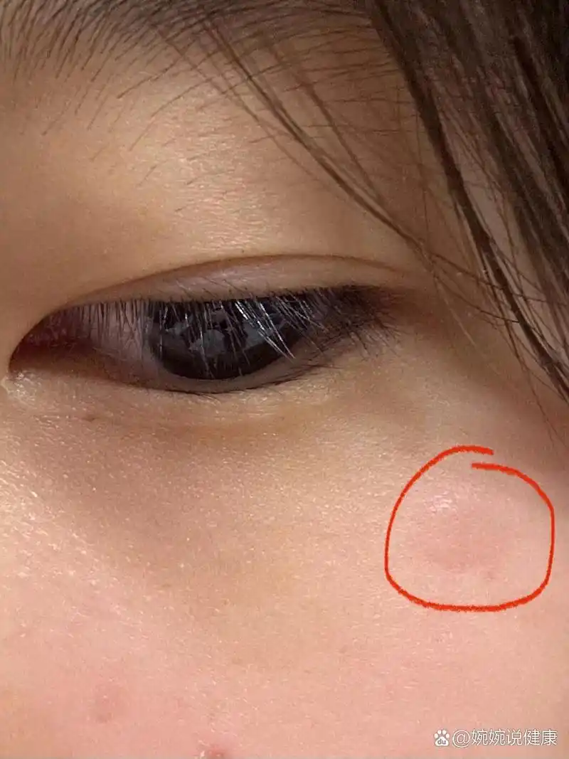 哭完眼睛下边长个小包是怎么回事 之前哭完也长这种包 好像位置是一样