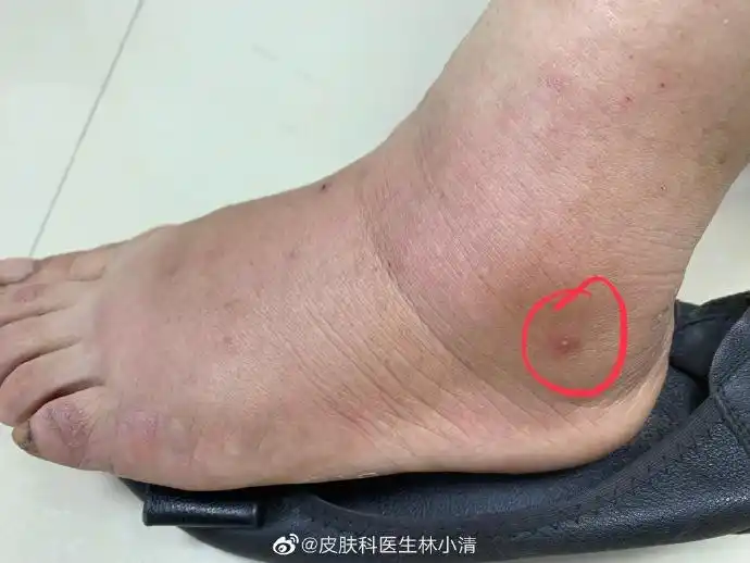 皮肤科医生林小清蚂蚁叮咬,如果有发现蚂蚁叮咬需要及时去医院就诊