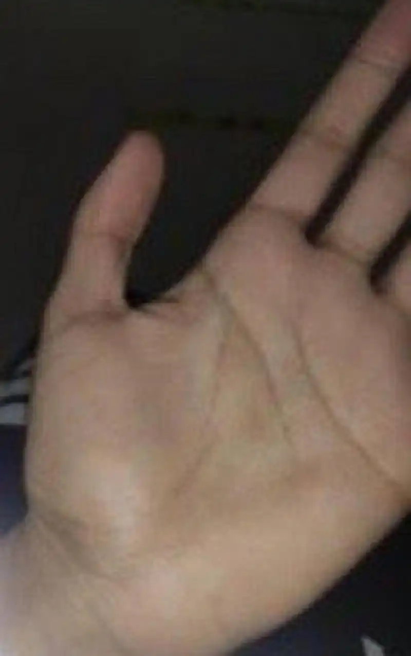 [cp]手相分析:  手指细长手掌瘦削生命线折断寓意先天体质较弱,同时