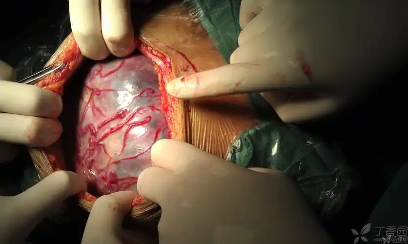 【资源】胎盘植入图片(原创) [病例帖]