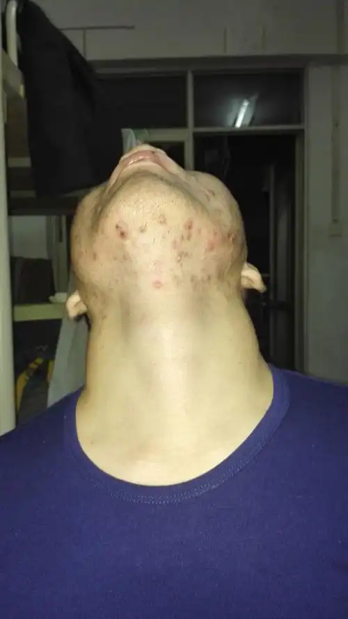 本人患有丘疹性痤疮,想达人推荐洗脸方法和平时补水补湿(超强油性皮肤