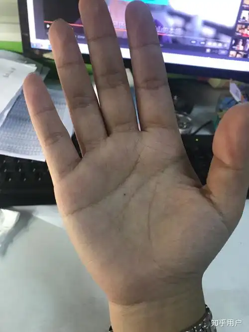 右手掌心突然长了一颗痣从医生那里得到了一个让我疑惑不解的答案我该