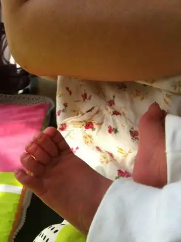 大家宝宝的大脚拇指是这样的吗?