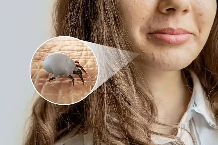 清洗消毒床单被褥,室内不清洁,在潮湿的环境中生活,容易导致螨虫滋生