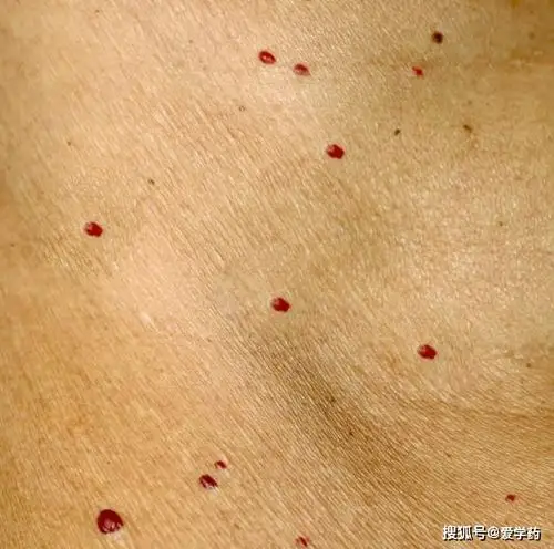 身上有这种小红痣,千万别大意,或是大病的预警信号_手机搜狐网