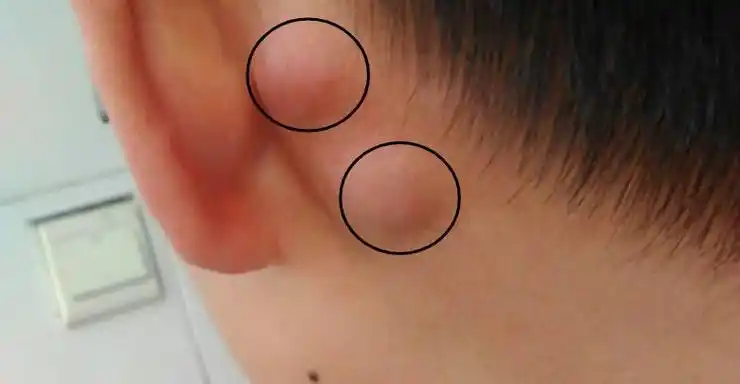 耳朵根下面起包__耳根下面突然长了包