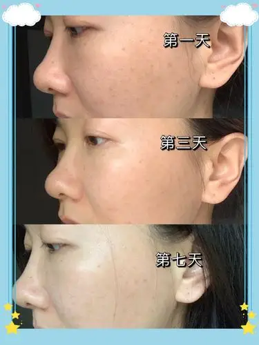 做完光子嫩肤一周,_圈子-新氧美容整形