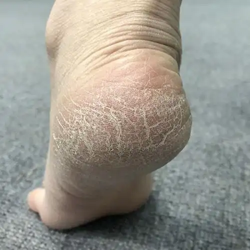 什么样的肤质需要去角质有什么真正有效不伤皮肤的去角质办法