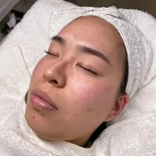 混合性皮肤护理步骤