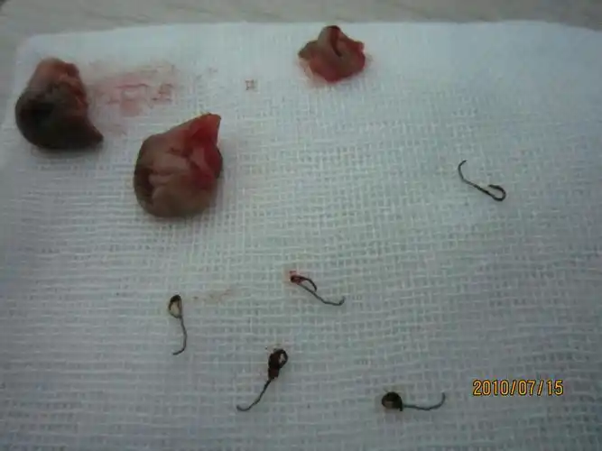 混合痔手术3年钛钉怎么没有未脱