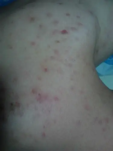 曾经治疗情况及是否有过敏,遗传病史:血热.