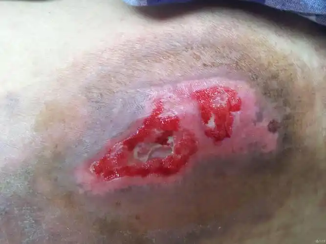 3个月治愈背部巨大褥疮海藻敷料治疗病例1例