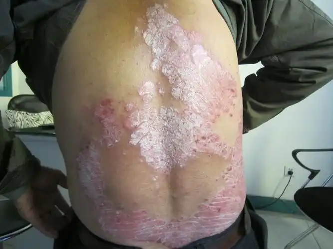 阿维a能治好牛皮癣吗