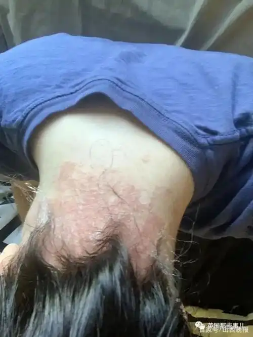美国妹子染发后严重过敏头肿成两倍大忽视了一个重要操作2