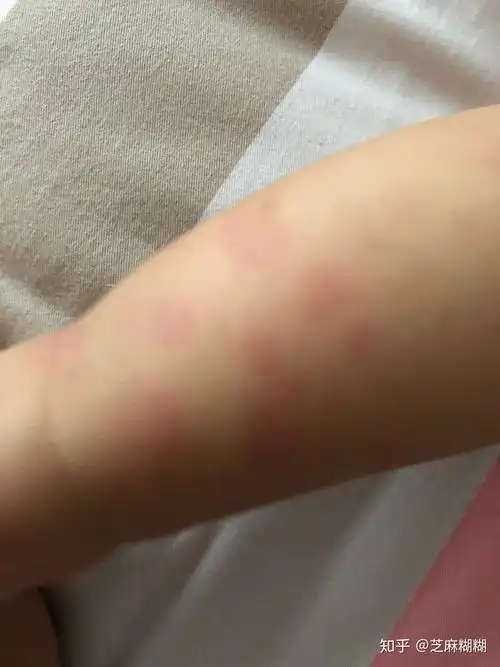 宝宝长荨麻疹了,我该怎么护理?