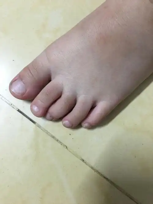 小孩2岁 左脚中指对比其它脚趾有点不正常,但是走路跑步没有任何异常