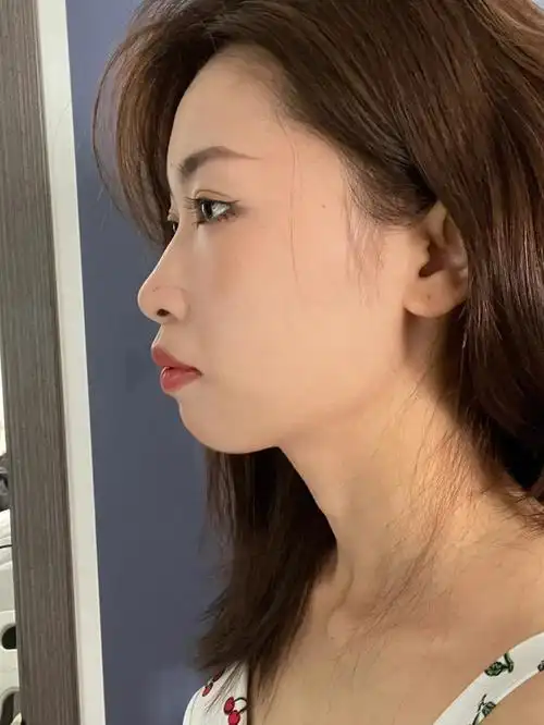 牙套  #骨性凸嘴  #正畸