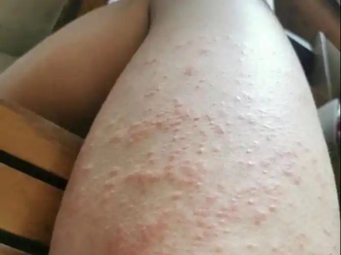 3分钟学会这个法子!拯救密密麻麻的湿疹很轻松,在家就能好