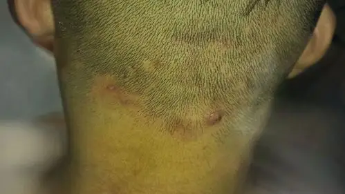 我脑勺后长的脂溢性皮炎 其中有一个又红又大 其他的都是暗紫色 以前