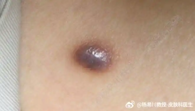 淡褐色结节,下肢最常见▲图1 皮肤纤维瘤 呈褐色结节,质硬表面常呈