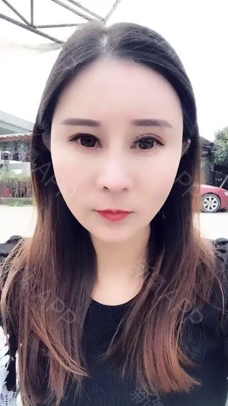 医生说脂肪填充的恢复期是1-3个